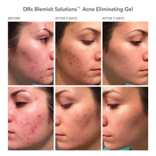 Load image into Gallery viewer, DRx Blemish Solutions Acne Eliminating Gel
