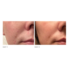 Load image into Gallery viewer, DRx Blemish Solutions Acne Eliminating Gel
